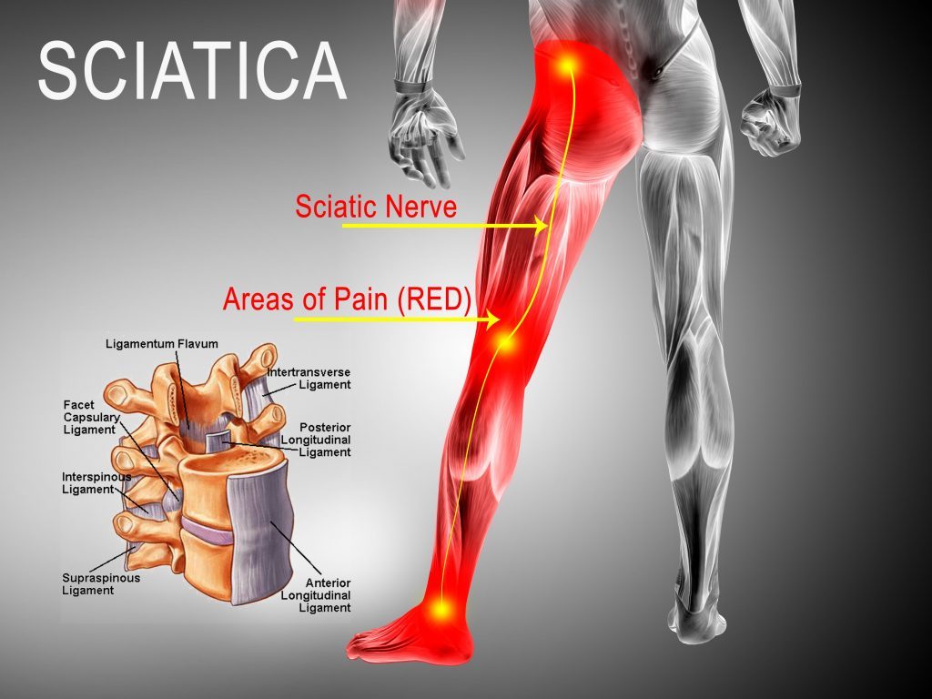 Understanding Sciatica: The Role of the Sciatic Nerve in Pain & Mobility