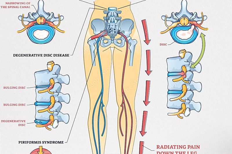 Sciatica — “a pain in the butt”