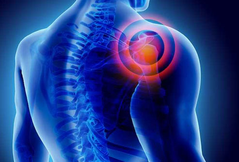 Breaking Free from Frozen Shoulder